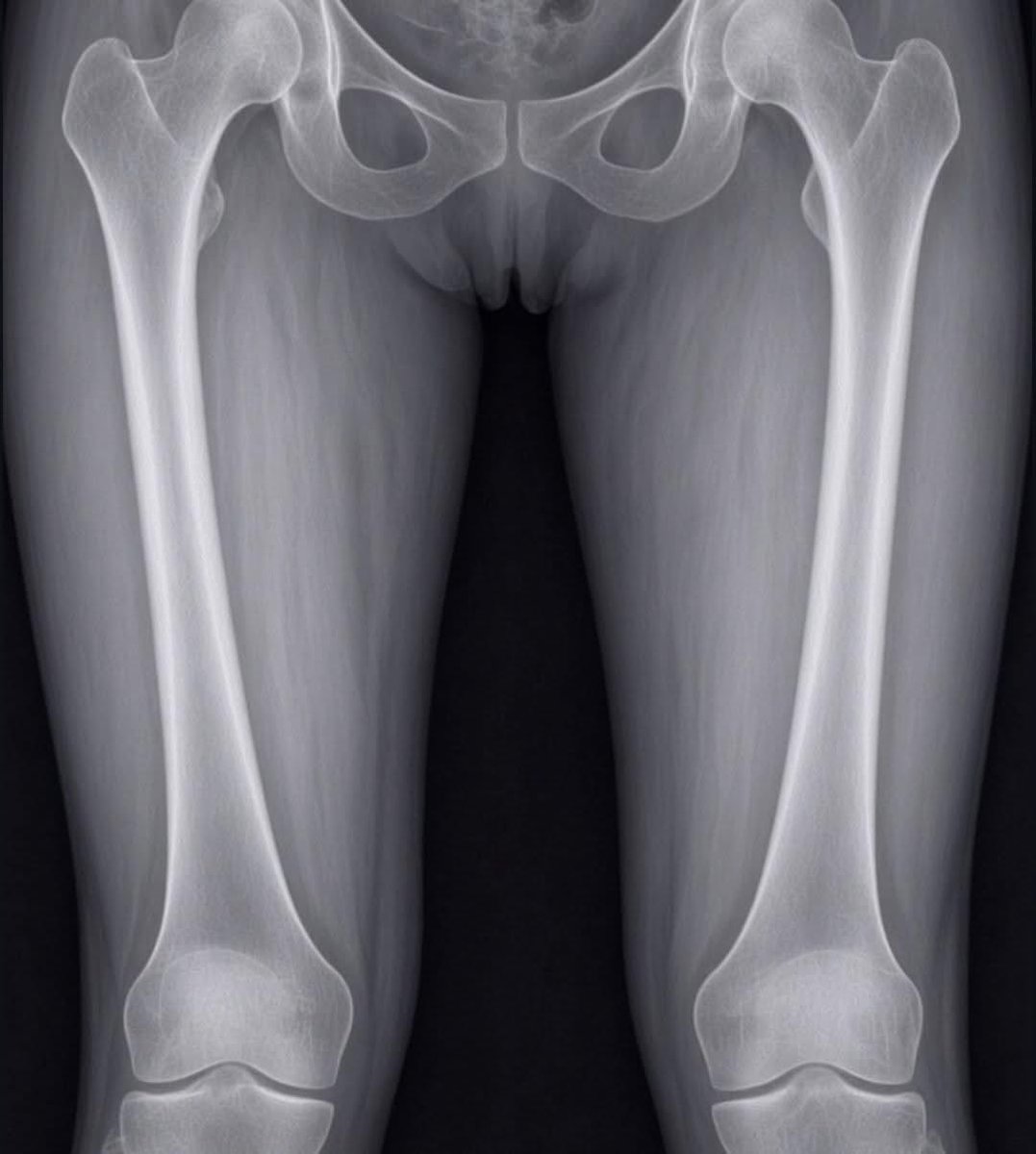 Cheesehead12821's tweet photo. @CalebBears1 Caleb Williams x ray from his hamstring https://t.co/0zQE5fYgmp