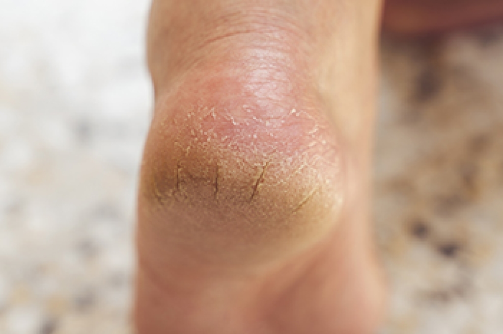 SCFootSpec's tweet photo. Cracked Heels and the Pressure of Daily Habits dlvr.​it/TVpBsD https://t.co/JE75aggBfM