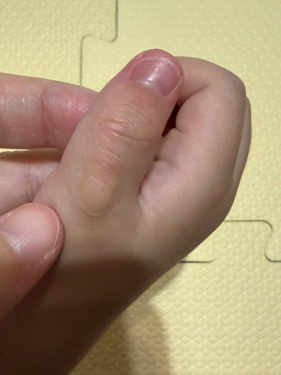 AffluentMist's tweet photo. Calling all parents for advice 🙏🏻

How did you get your 2-year-9-month-old to stop sucking their fingers? 🥲

The sucking has gotten so intense that they’ve developed calluses on their fingers and their nails are starting to change shape.

I’ve tried a few things, but nothing seems to be working. 😭

Parents who’ve been through this, what actually worked for you? Please share your tips! 🙏🏻
