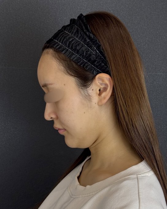 A woman shown in profile view wearing a black ruffled headband, displaying the area from her chin to neck. The image illustrates the submental region relevant to the post about submental liposuction, emphasizing the importance of choosing a surgeon capable of handling potential bleeding and airway emergencies during this procedure.