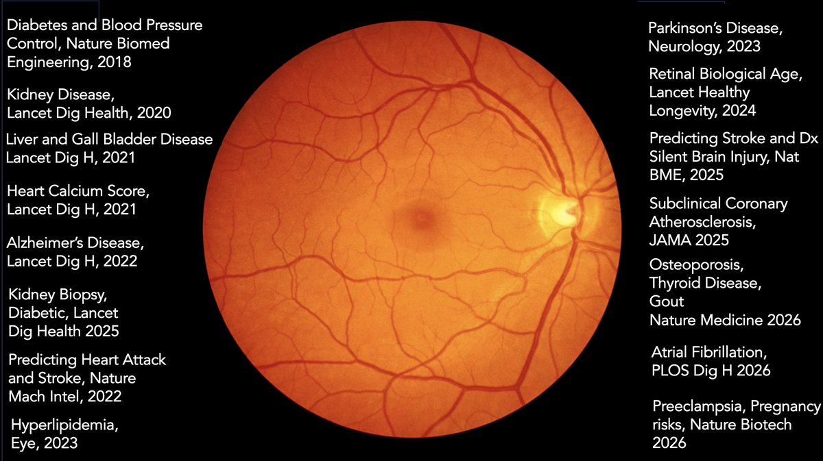 EricTopol's tweet photo. The richness of the retina photo or OCT predictive data, as interpretable by AI, but not expert physicians, is extraordinary. Today a new report on retina AI for preeclampsia and pregnancy vascular risks @NatureBiotech https://t.co/A3XyZA3vjg
My summary of the key 15 publications on this topic here