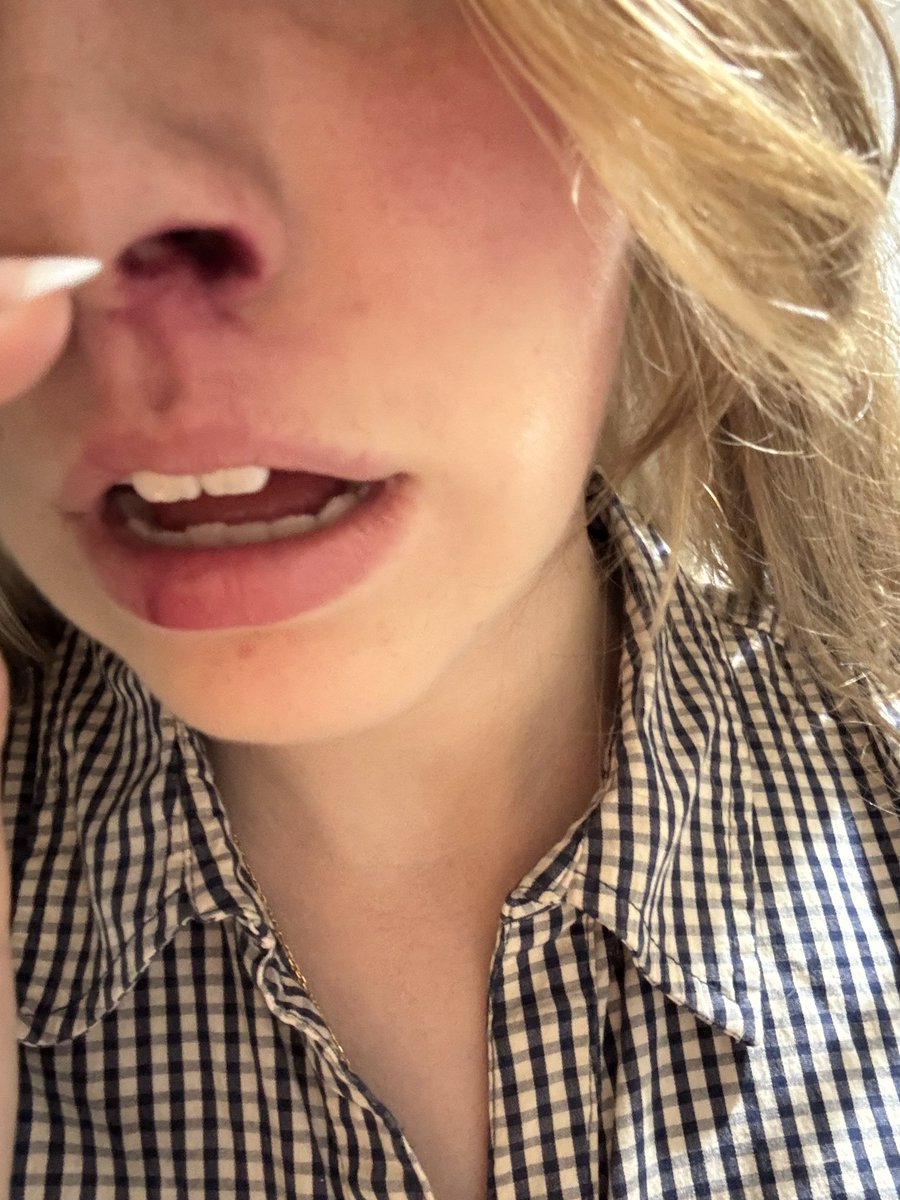 _starmi_'s tweet photo. Update j’ai fait des photos en arrivant chez moi de mes blessures à cause d’un CRS qui m’a projetée au sol https://t.co/YOxrKx2rSL