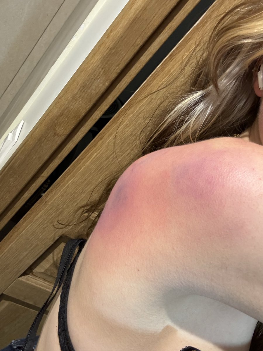 _starmi_'s tweet photo. Update j’ai fait des photos en arrivant chez moi de mes blessures à cause d’un CRS qui m’a projetée au sol https://t.co/YOxrKx2rSL