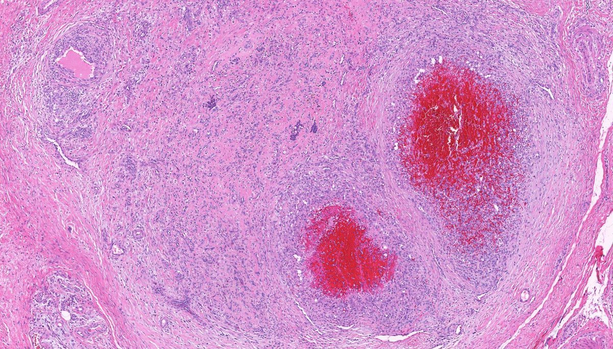 JMGardnerMD's tweet photo. I ❤️ "bonus" findings in #pathology! What are these incidental round blue cells in a pyogenic granuloma/lobular capillary hemangioma? 
WSI digital slides: https://t.co/zLeF9rCrrC. 
Answer: https://t.co/BCAq4rkBfW 
#dermpath #dermatology #dermtwitter #BSTpath #hemepath https://t.co/IM4R6bAfkE