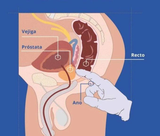 YosuepEstebanX's tweet photo. CÁNCER DE PRÓSTATA: 8 DATOS QUE TODO HOMBRE DEBERÍA CONOCER

1. LA EDAD IMPORTA ⏳ https://t.co/evQVrFzB0T