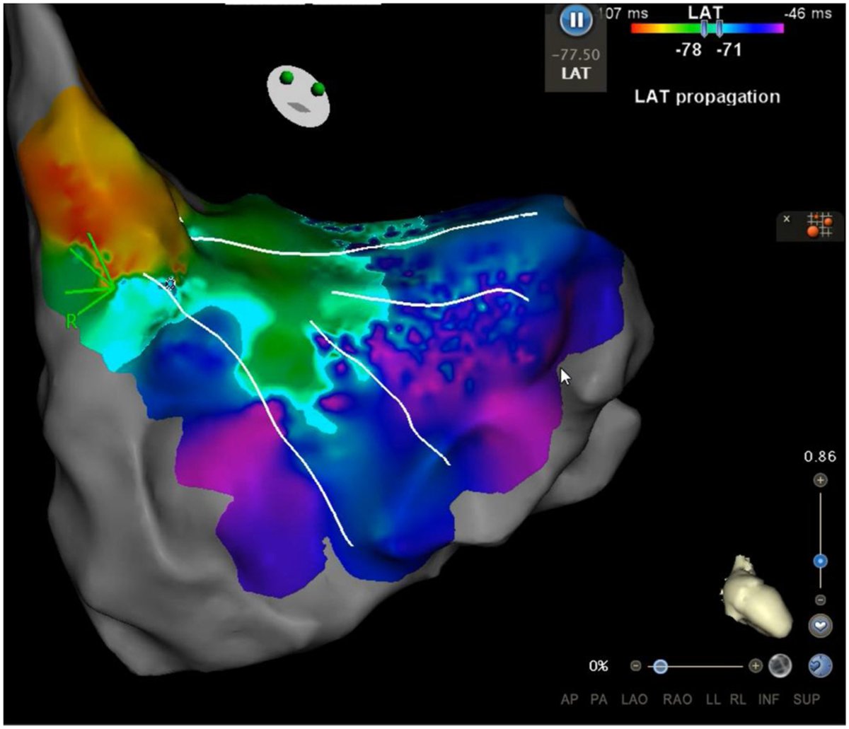 HRS_CaseReports's tweet photo. Purkinje De-networking to Treat Suspected Purkinje Originated PVC-triggered Ventricular Fibrillation 
@rm_evans 
https://t.co/H7W1juY8DZ https://t.co/keLckmTqAx