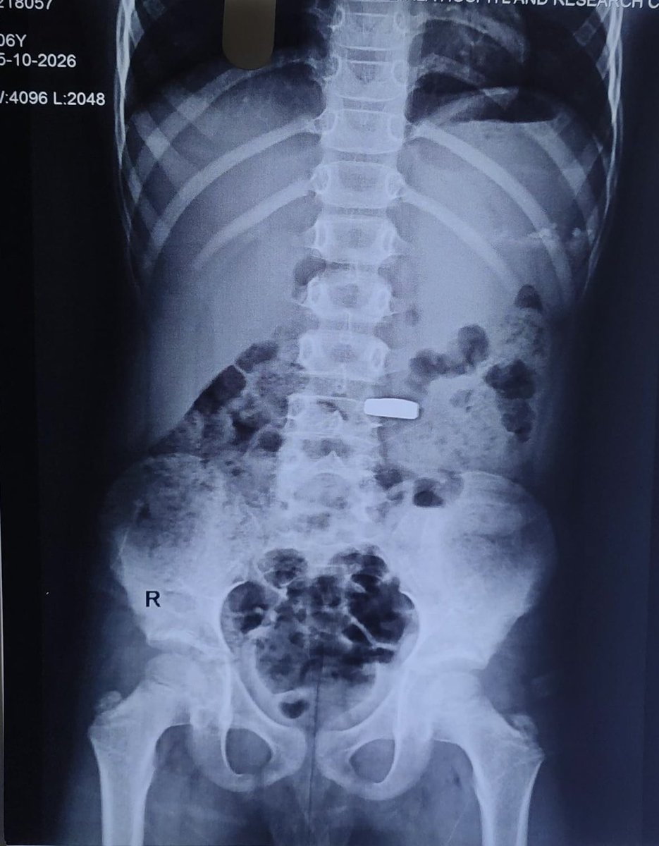 Lap_surgeon's tweet photo. 6 years old Boy! 

What should I do?🤔
#MedTwitter 
      Night.                                    Morning https://t.co/w3OPaP0JTh