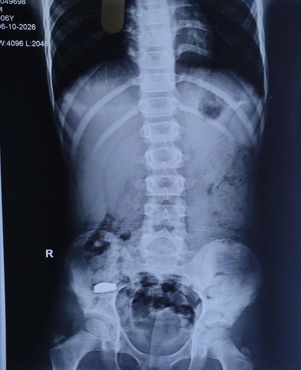 Lap_surgeon's tweet photo. 6 years old Boy! 

What should I do?🤔
#MedTwitter 
      Night.                                    Morning https://t.co/w3OPaP0JTh