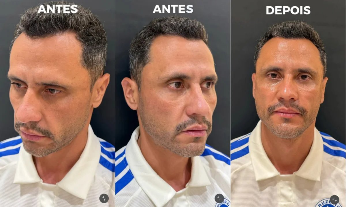 republiqueBRA's tweet photo. 📸 Após ser eleito governador de Minas Gerais, Cleitinho realiza procedimento estético no rosto. https://t.co/QTAKmU4q5p