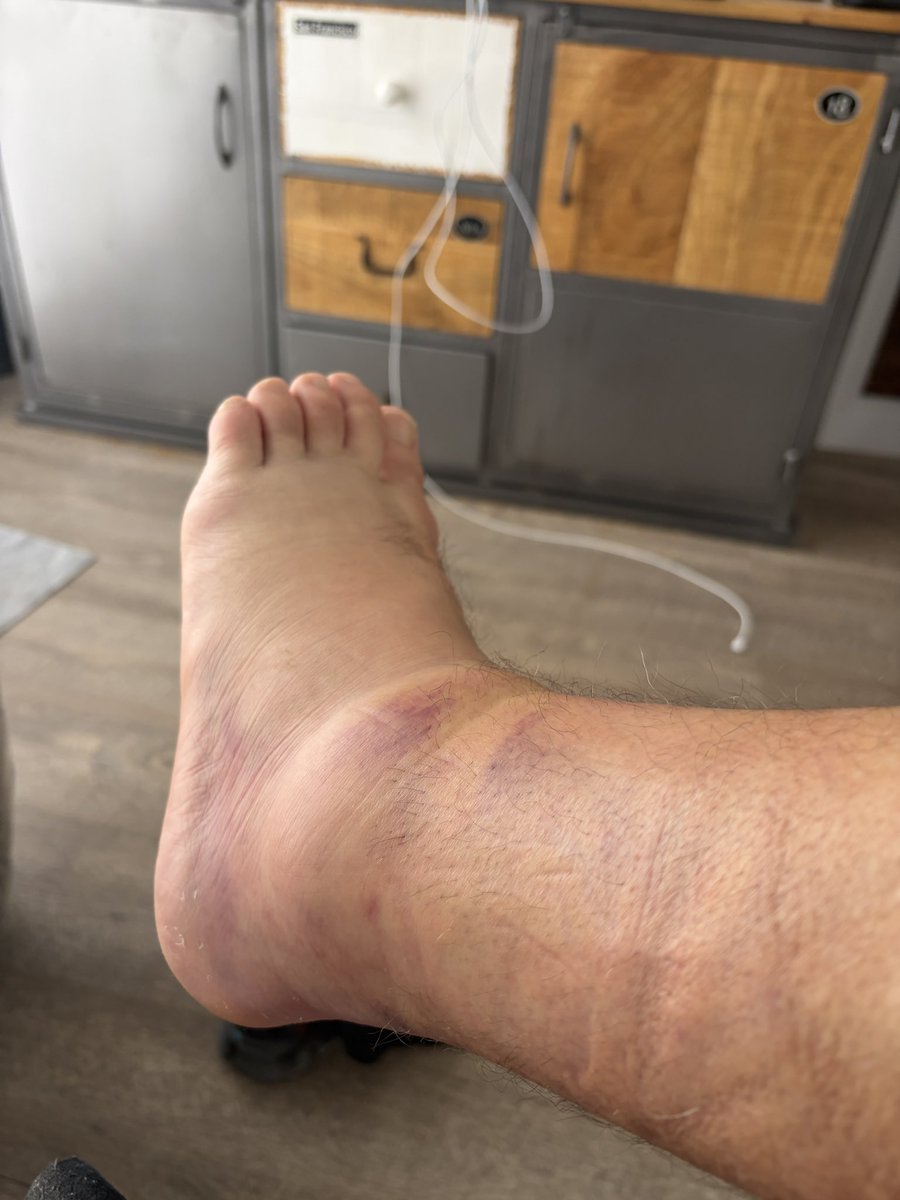 HotRawHole2Fill's tweet photo. Within the first hour on the island, trip over and BADLY sprain ankle, which is now a Kankle. In bed, one leg up (instead of two), for R-I-C-E https://t.co/Cmu7eknKxn