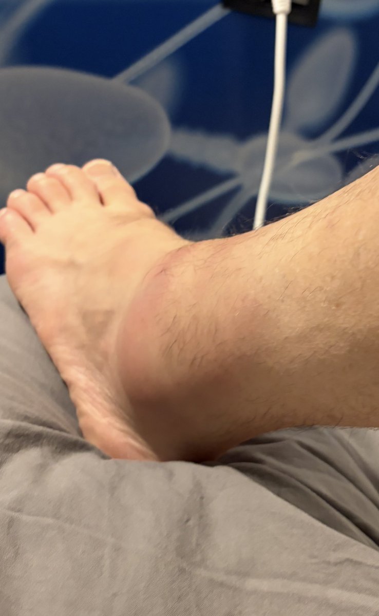 HotRawHole2Fill's tweet photo. Within the first hour on the island, trip over and BADLY sprain ankle, which is now a Kankle. In bed, one leg up (instead of two), for R-I-C-E https://t.co/Cmu7eknKxn