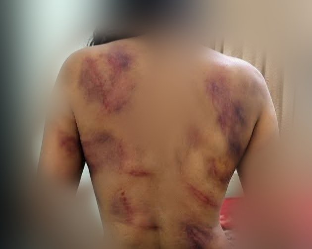 Delhiite_'s tweet photo. She is only 24. Her name is Anju and her body tells a story no woman should ever have to live. Bruises cover her back, her shoulders, her arms. Long red marks scar her skin. All because her dowry was "not enough."

Her husband, Nandu, allegedly beat her with a pressure cooker, a grinding stone, a belt, and a mobile charger during five brutal days in Saudi Arabia.

When she returned home to Kerala, the torture continued. A case has now been filed against Nandu and his parents.

Doctors said her wounds were too old to stitch. Too old. Let that sink in.

📍Kollam, Kerala