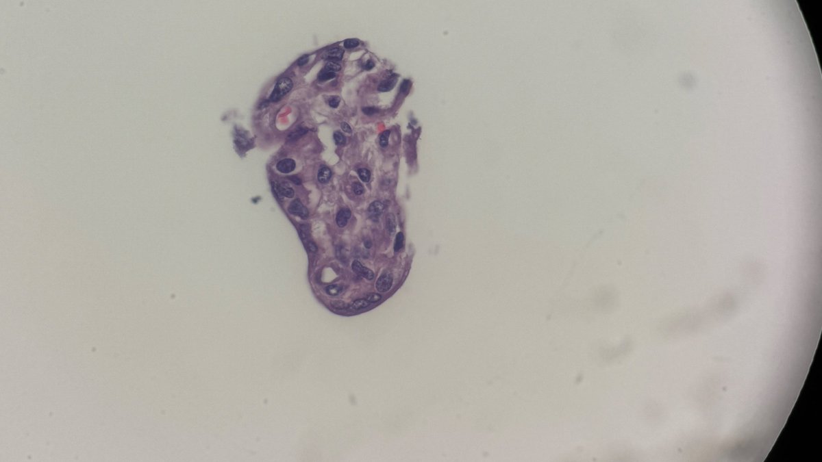 Andresangel3's tweet photo. #Cytopathology #CytoPath #PathTwitter #CytoCase #Pathology  75 yo man with left level 5 superior neck node. Smears are acellular. Cell block shows the 4 attached images. Your opinion…… https://t.co/iwZ6SaAEe2