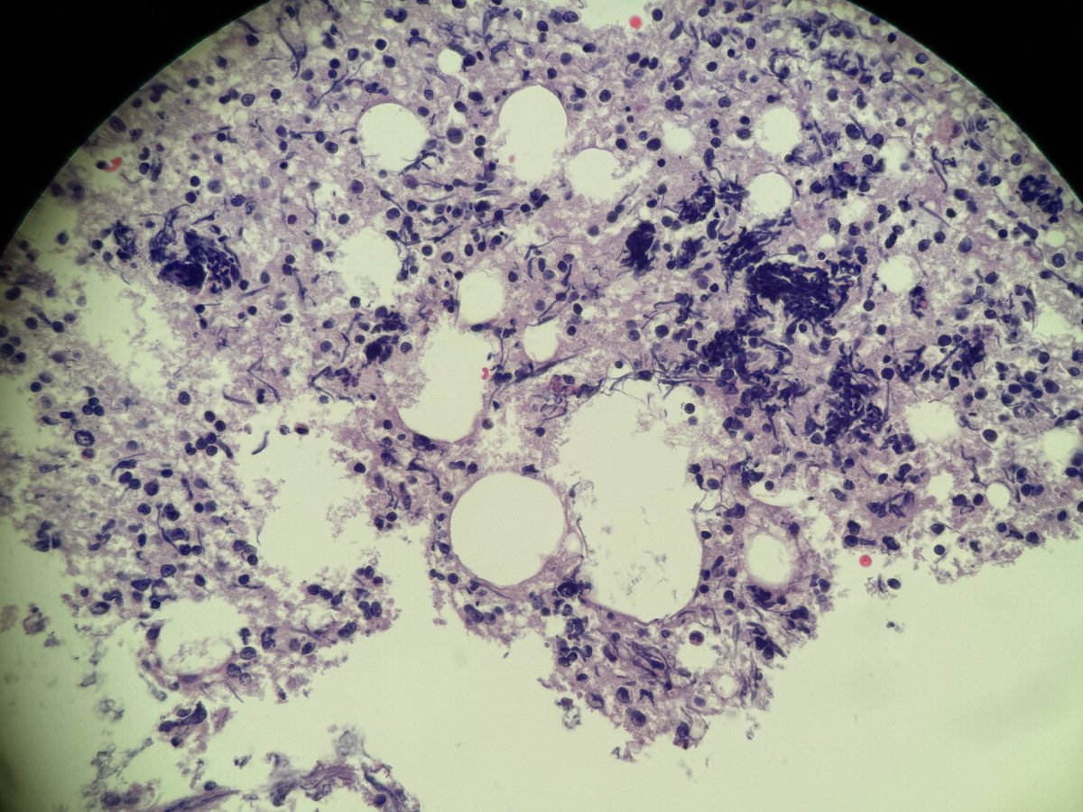 Andresangel3's tweet photo. #Cytopathology #CytoPath #PathTwitter #CytoCase #Pathology  75 yo man with left level 5 superior neck node. Smears are acellular. Cell block shows the 4 attached images. Your opinion…… https://t.co/iwZ6SaAEe2