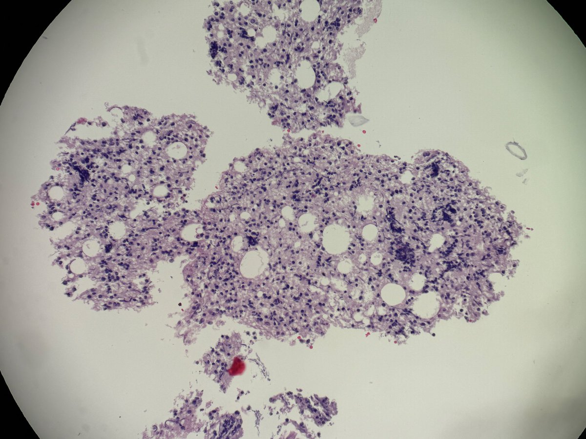 Andresangel3's tweet photo. #Cytopathology #CytoPath #PathTwitter #CytoCase #Pathology  75 yo man with left level 5 superior neck node. Smears are acellular. Cell block shows the 4 attached images. Your opinion…… https://t.co/iwZ6SaAEe2
