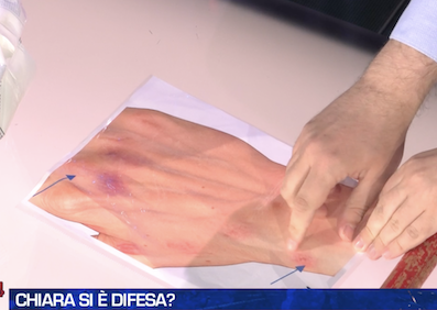 baboonjazzsoon's tweet photo. CHIARA SI E' DIFESA
arma=verosimilmente martello
DIFESA PASSIVA x proteggere il volto mentre veniva colpita=mano e polso
graffiature su caviglia (forse durante trascinamento ha tentato un calcio)=
posizioni tipiche difesa passiva
@Prof_FMGalassi ECCELSO 👏👏👏👏
#Garlasco #ore https://t.co/1I7Ui5NBlR