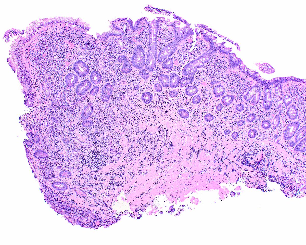 LizMontgomeryMD's tweet photo. Gastropathy associated with losartan with parietal cell loss mimics autoimmune gastritis but there is no enterochromaffin-like cell hyperplasia. There is only mild antral inflammation. This case has a collagenous gastritis pattern of injury. Note the pseudopyloric metaplasia. https://t.co/tXB62L8mi9