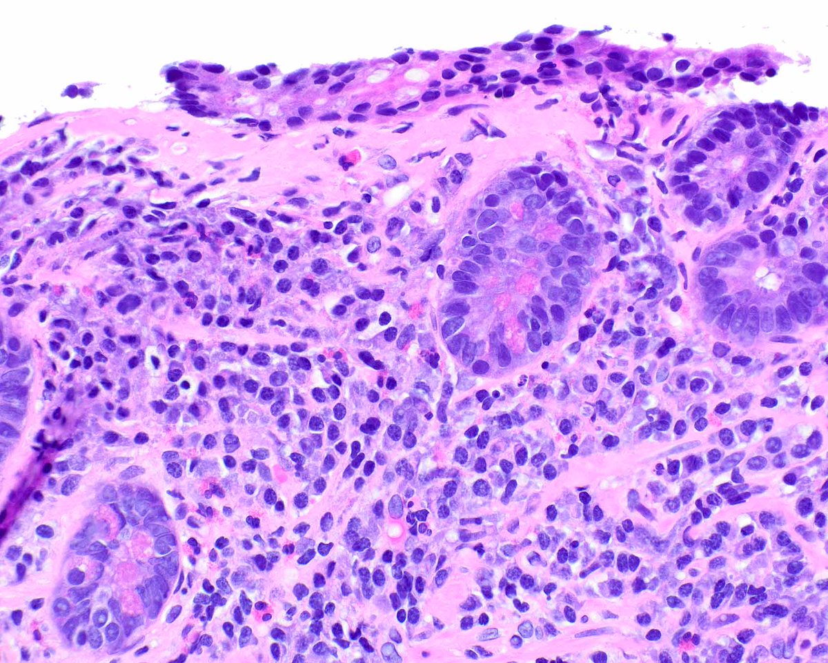 LizMontgomeryMD's tweet photo. Gastropathy associated with losartan with parietal cell loss mimics autoimmune gastritis but there is no enterochromaffin-like cell hyperplasia. There is only mild antral inflammation. This case has a collagenous gastritis pattern of injury. Note the pseudopyloric metaplasia. https://t.co/tXB62L8mi9