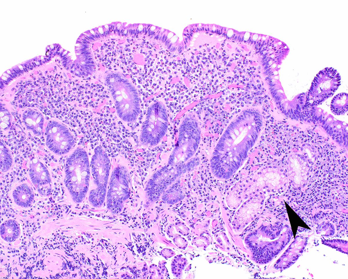 LizMontgomeryMD's tweet photo. Gastropathy associated with losartan with parietal cell loss mimics autoimmune gastritis but there is no enterochromaffin-like cell hyperplasia. There is only mild antral inflammation. This case has a collagenous gastritis pattern of injury. Note the pseudopyloric metaplasia. https://t.co/tXB62L8mi9