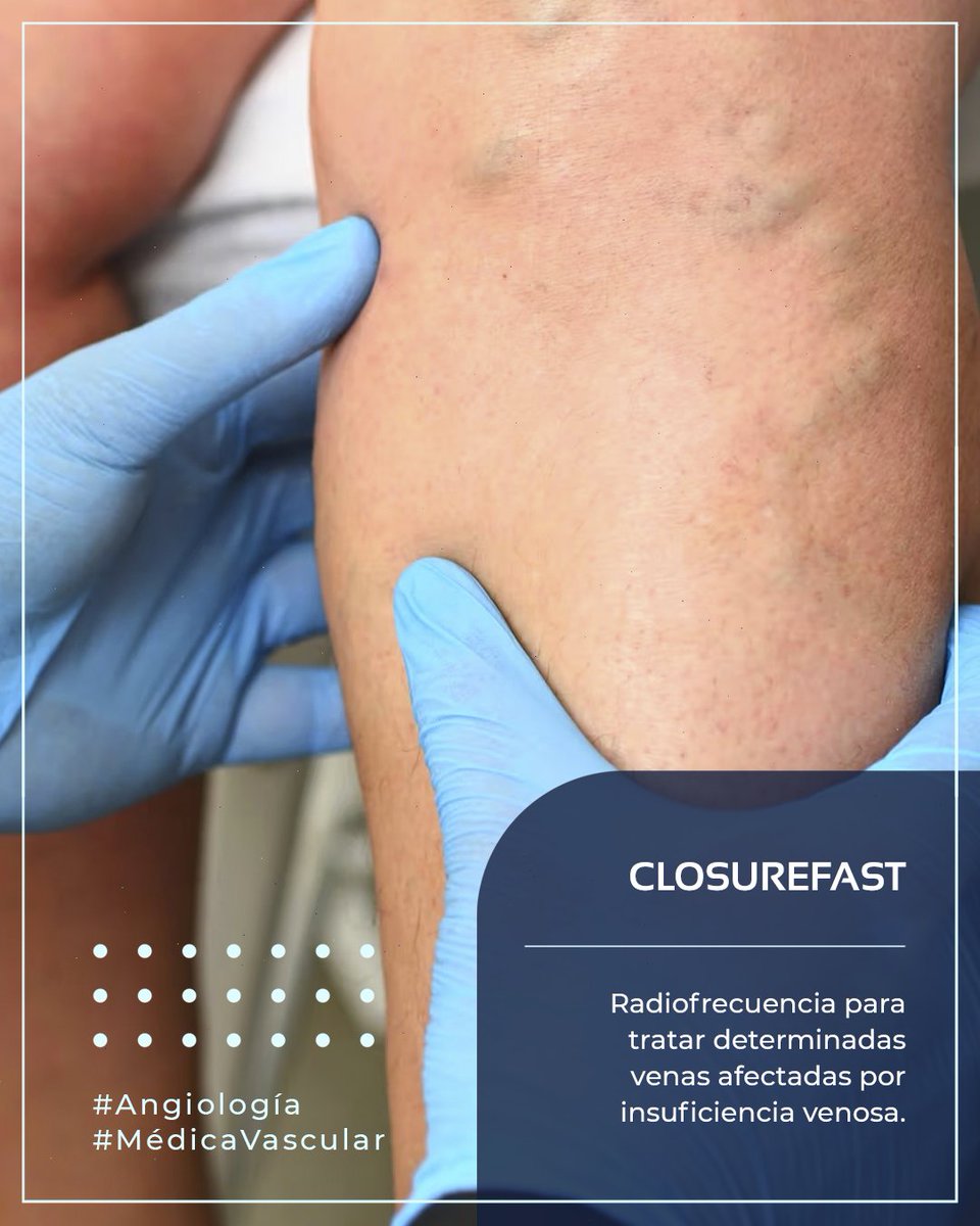 MedicVascular's tweet photo. CLOSUREFAST utiliza radiofrecuencia para tratar determinadas venas afectadas por insuficiencia venosa.

Es una alternativa mínimamente invasiva y ambulatoria para pacientes seleccionados.

📲 Escríbenos por WhatsApp: (477) 750-8662

#CLOSUREFAST #Radiofrecuencia #Várices https://t.co/x06VPI5pgw