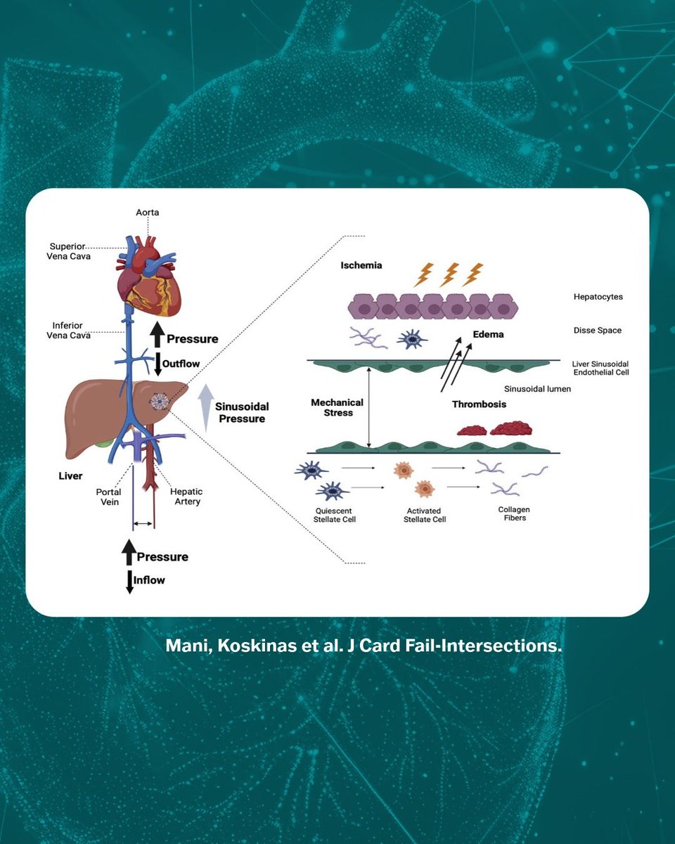 JCFINT's tweet photo. How should we assess congestive hepatopathy in advanced HF?

Conventional liver tests can be misleading. This State-of-the-Art review explores multimodality assessment, including biopsy &amp; HVPG, and individualized heart vs heart-liver transplant decisions.

https://t.co/ioASmkSTX9 https://t.co/szMnyTvfHZ