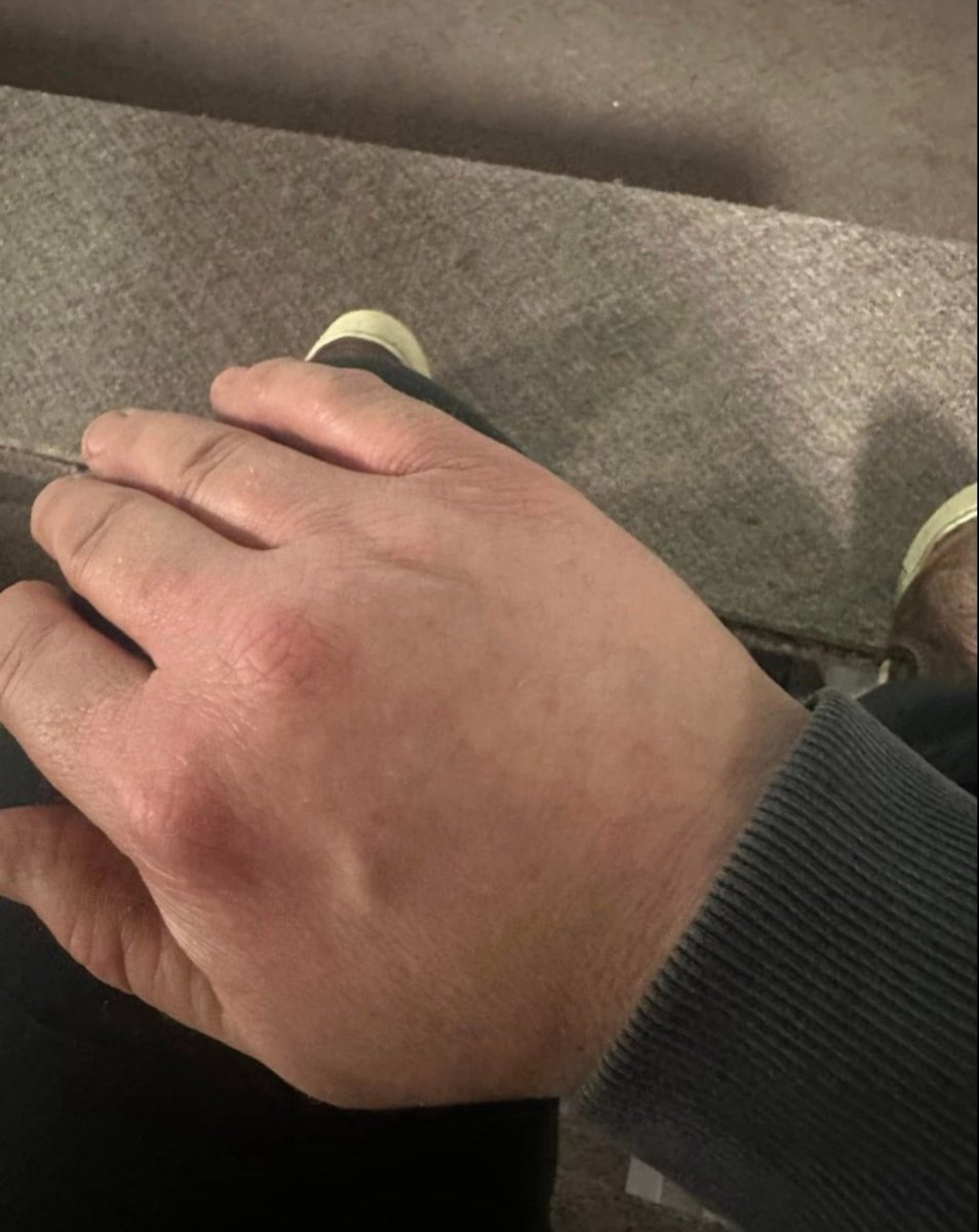 JoeTippensl's tweet photo. Okay, I'm going to share something real.
Psoriasis is a bitch. I've had it for 20 years.

20 years of itching. 20 years of hiding. 20 years of feeling like my skin wasn't mine.

I couldn't take it anymore.
I was covered completely in 2024. Head to toe. It was depressing. The kind of depressing that makes you not want to leave the house.

I tried everything. Creams. Shots. Prescriptions. Nothing worked. Not really.

Then I found a page about Ivermectin and cancer.
And I read something that stopped me: Psoriasis might be caused by parasites.

I thought, "What the hell – I deworm my animals. Why not myself?"

So I did it.

3 rounds of Ivermectin

3 rounds of Safeguard (Fenbendazole)

Total 6 weeks

1 week rest after each round

And my friends… it freaking worked.
I'm not crawling under my skin anymore.

I sleep better.

That time of the month? Barely makes me sick now.

I go number 2 every dang day – which I never did before.

My skin is healed.
I can't believe I'm saying that.

After 20 years of suffering.

I trust my gut.
And I'm glad I did.

Call me crazy. I don't care. Because I'm not crazy.

I'm just someone who tried something different and got her life back.

Follow me for more success stories that will shock you.