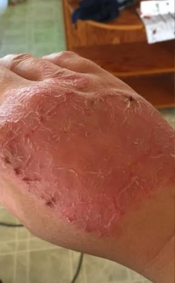 JoeTippensl's tweet photo. Okay, I'm going to share something real.
Psoriasis is a bitch. I've had it for 20 years.

20 years of itching. 20 years of hiding. 20 years of feeling like my skin wasn't mine.

I couldn't take it anymore.
I was covered completely in 2024. Head to toe. It was depressing. The kind of depressing that makes you not want to leave the house.

I tried everything. Creams. Shots. Prescriptions. Nothing worked. Not really.

Then I found a page about Ivermectin and cancer.
And I read something that stopped me: Psoriasis might be caused by parasites.

I thought, "What the hell – I deworm my animals. Why not myself?"

So I did it.

3 rounds of Ivermectin

3 rounds of Safeguard (Fenbendazole)

Total 6 weeks

1 week rest after each round

And my friends… it freaking worked.
I'm not crawling under my skin anymore.

I sleep better.

That time of the month? Barely makes me sick now.

I go number 2 every dang day – which I never did before.

My skin is healed.
I can't believe I'm saying that.

After 20 years of suffering.

I trust my gut.
And I'm glad I did.

Call me crazy. I don't care. Because I'm not crazy.

I'm just someone who tried something different and got her life back.

Follow me for more success stories that will shock you.