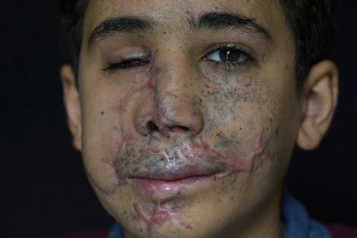 ChanosNicholas's tweet photo. Yes.

The photo in that post is of Hussein Dheini, a Lebanese boy from the village of Teir Debba in southern Lebanon. 

On 17 September 2024 he picked up his father’s pager after it made an unusual buzzing sound. The device exploded in his hands/face. He lost his right eye, suffered damage to the left eye, had teeth and the tip of his nose blown off, and lost parts of fingers on both hands. His father was a Hezbollah member; the boy himself was in the group’s youth scouts.