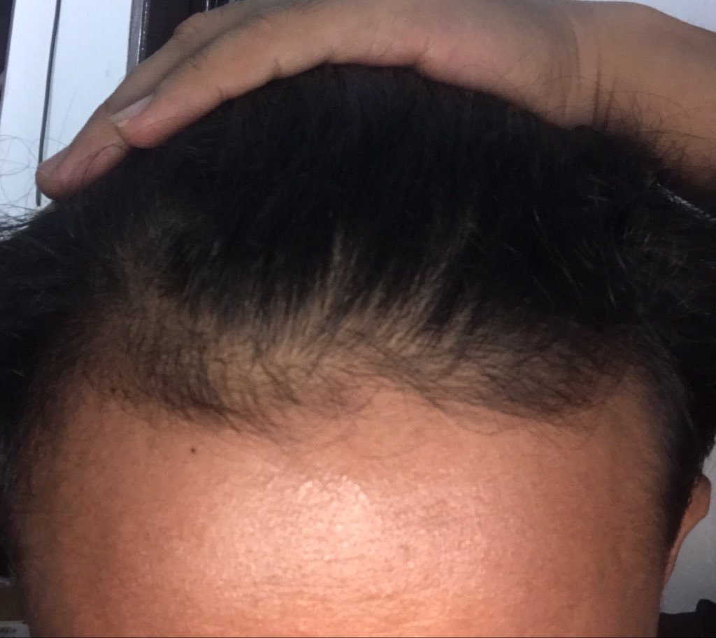 TLD_Survive's tweet photo. Good morning and have a nice day !!
so happy rambutku terlihat mulai menembal di area kebotakan karena genetik/hormonal.. 🙂🙂
#KebotakanGenetik #BlackMoresUltimateRadianceSkin #VitD3 https://t.co/Tu9IYw3bNk