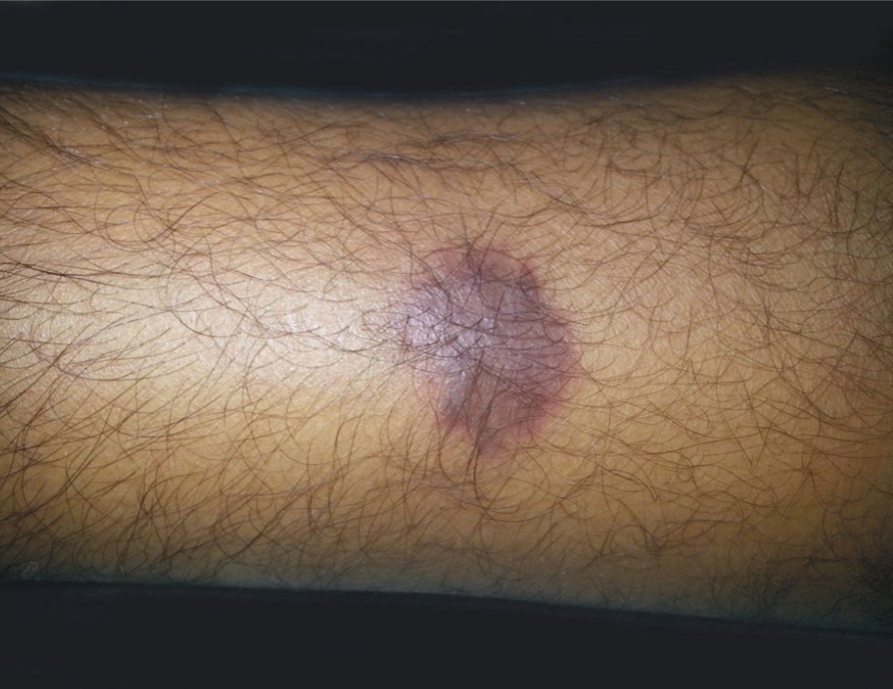 docakx's tweet photo. Sign of active HIV/AIDS. 
What is this? https://t.co/b7LhoKoCbj