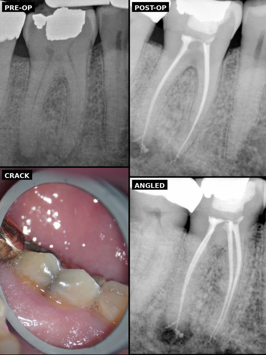 drjonathanuhles's tweet photo. Myth: Cracked ≠ doomed.

Tooth #30: Necrotic pulp + SAP (Symptomatic Apical Periodontitis) ; crack through lingual sulcus, paper-thin roots.

Conservative shaping (15/.04, 25/.04) + GentleWave for cleaning/disinfection. Brasseler Bioceramic sealer.

Precision + science = saved. #Endodontics #worthsaving
