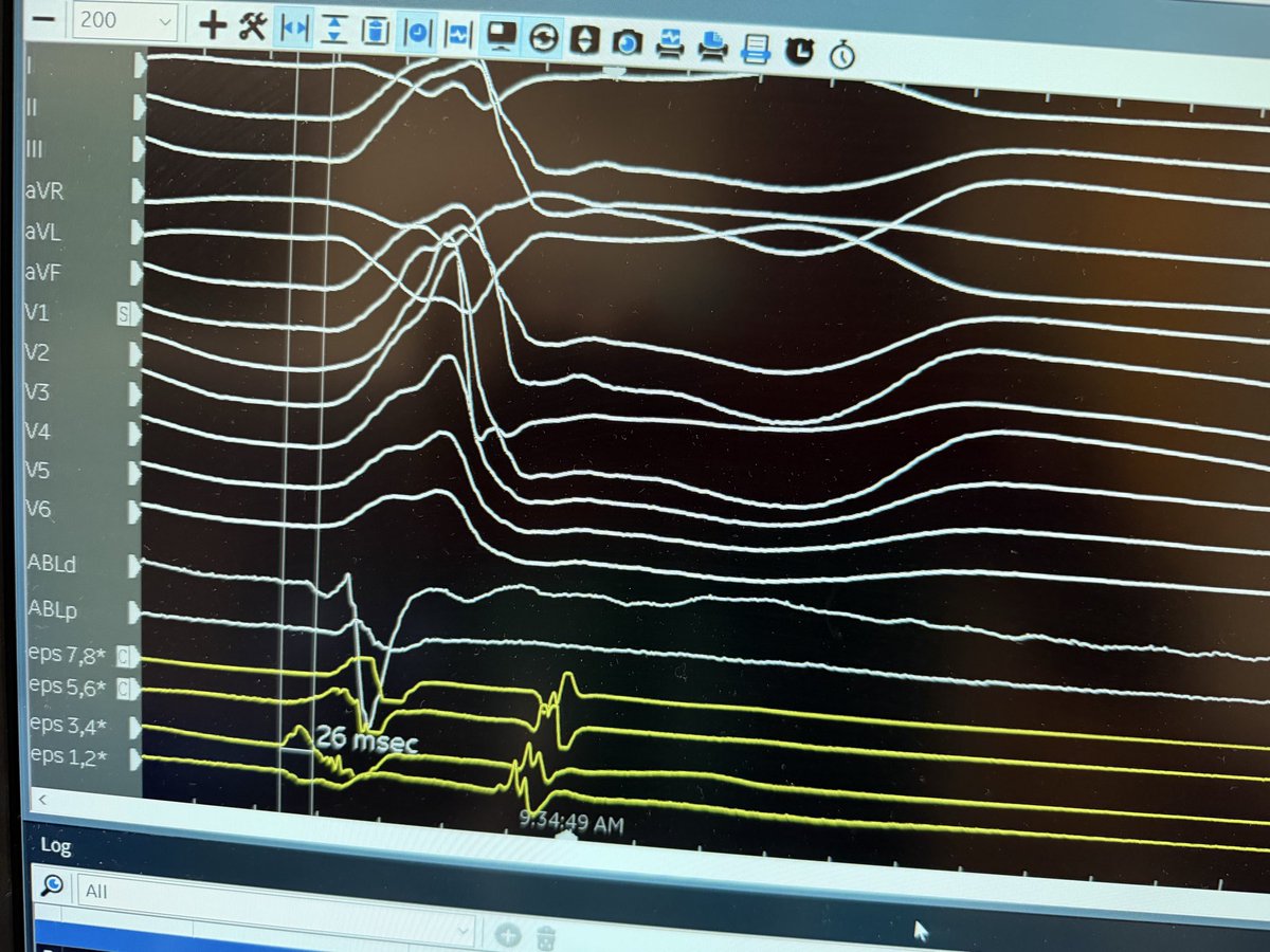 AatishGarg_EP's tweet photo. First case in Northeast with Tactiflex DUO and what a great case it turned out - epicardial LV summit pvc mapped earliest with EP star epicardially , successfully ablated endocardial with stacked PFA despite being barely on time endocardial. 

@EPeeps_Bot @AbbottCardio https://t.co/6bOQotxpGD