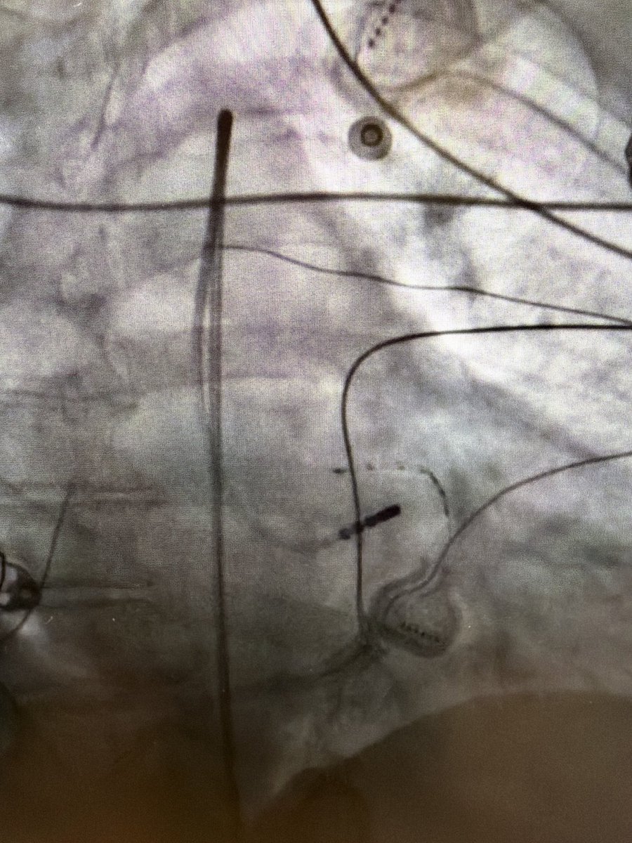 AatishGarg_EP's tweet photo. First case in Northeast with Tactiflex DUO and what a great case it turned out - epicardial LV summit pvc mapped earliest with EP star epicardially , successfully ablated endocardial with stacked PFA despite being barely on time endocardial. 

@EPeeps_Bot @AbbottCardio https://t.co/6bOQotxpGD
