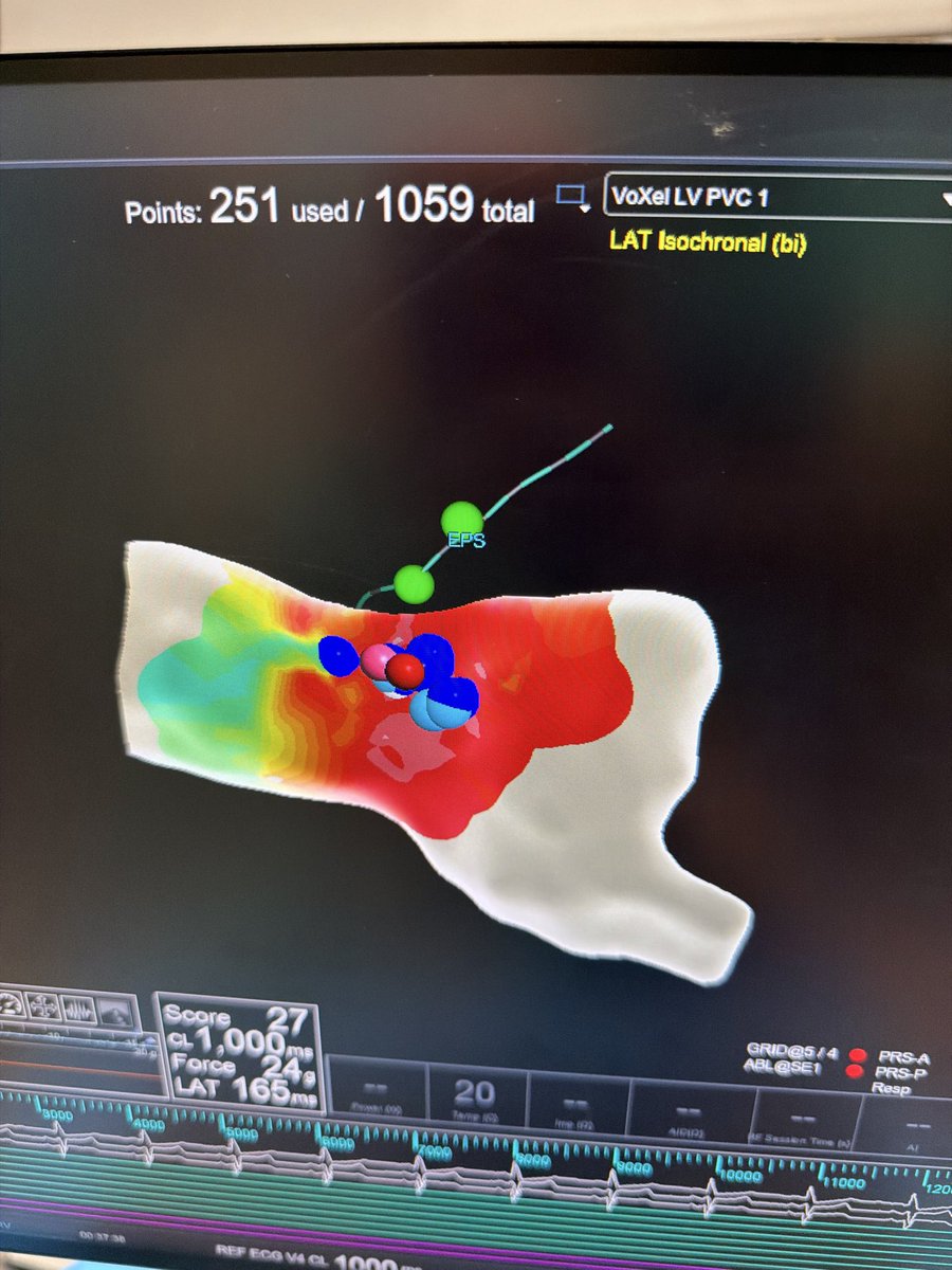 AatishGarg_EP's tweet photo. First case in Northeast with Tactiflex DUO and what a great case it turned out - epicardial LV summit pvc mapped earliest with EP star epicardially , successfully ablated endocardial with stacked PFA despite being barely on time endocardial. 

@EPeeps_Bot @AbbottCardio https://t.co/6bOQotxpGD