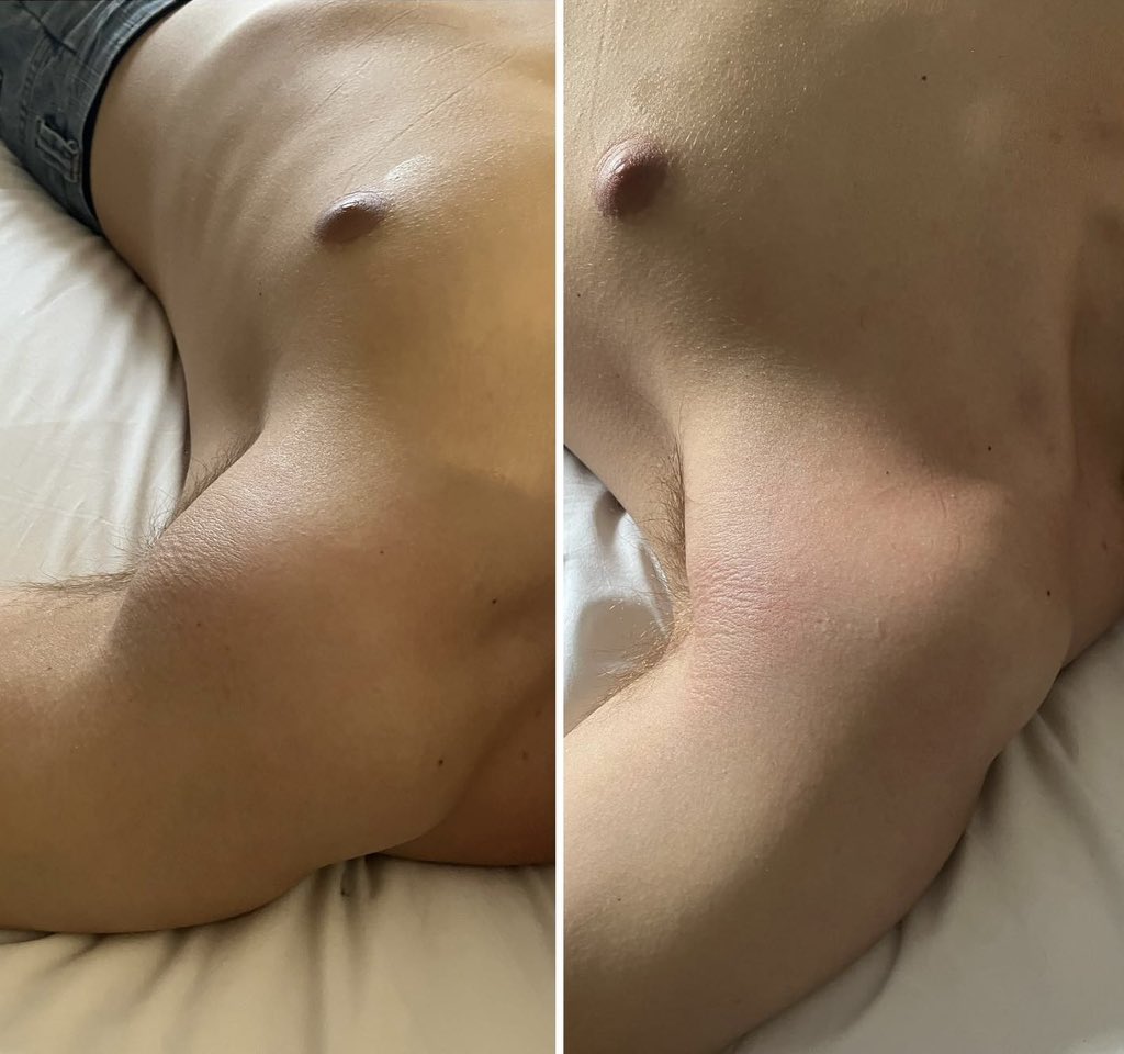 RebeccaTalbot01's tweet photo. BEFORE AND AFTER

Worked on client partners shoulder. They were having so much pain inside the deltoid and he  couldn't sleep at night.

Pain has subsided 70% in a quick 15 minute session

Love what I do❤️

#RegisteredMassageTherapist #MassageTherapy
#MassageTherapist #SelfCare https://t.co/kg2eKpSGIL
