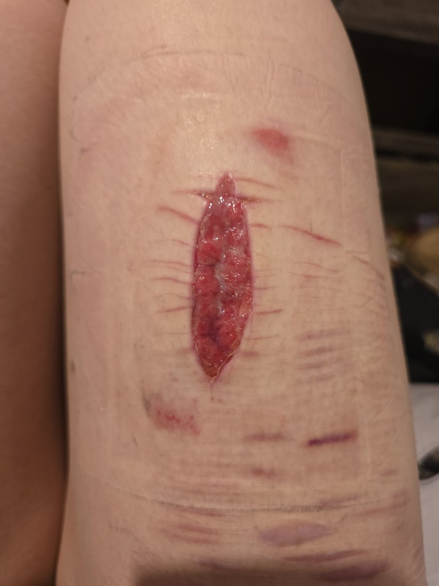 itttskayla's tweet photo. Healing day 8!! #shtwtt #988twt https://t.co/hDjOYJsYkp