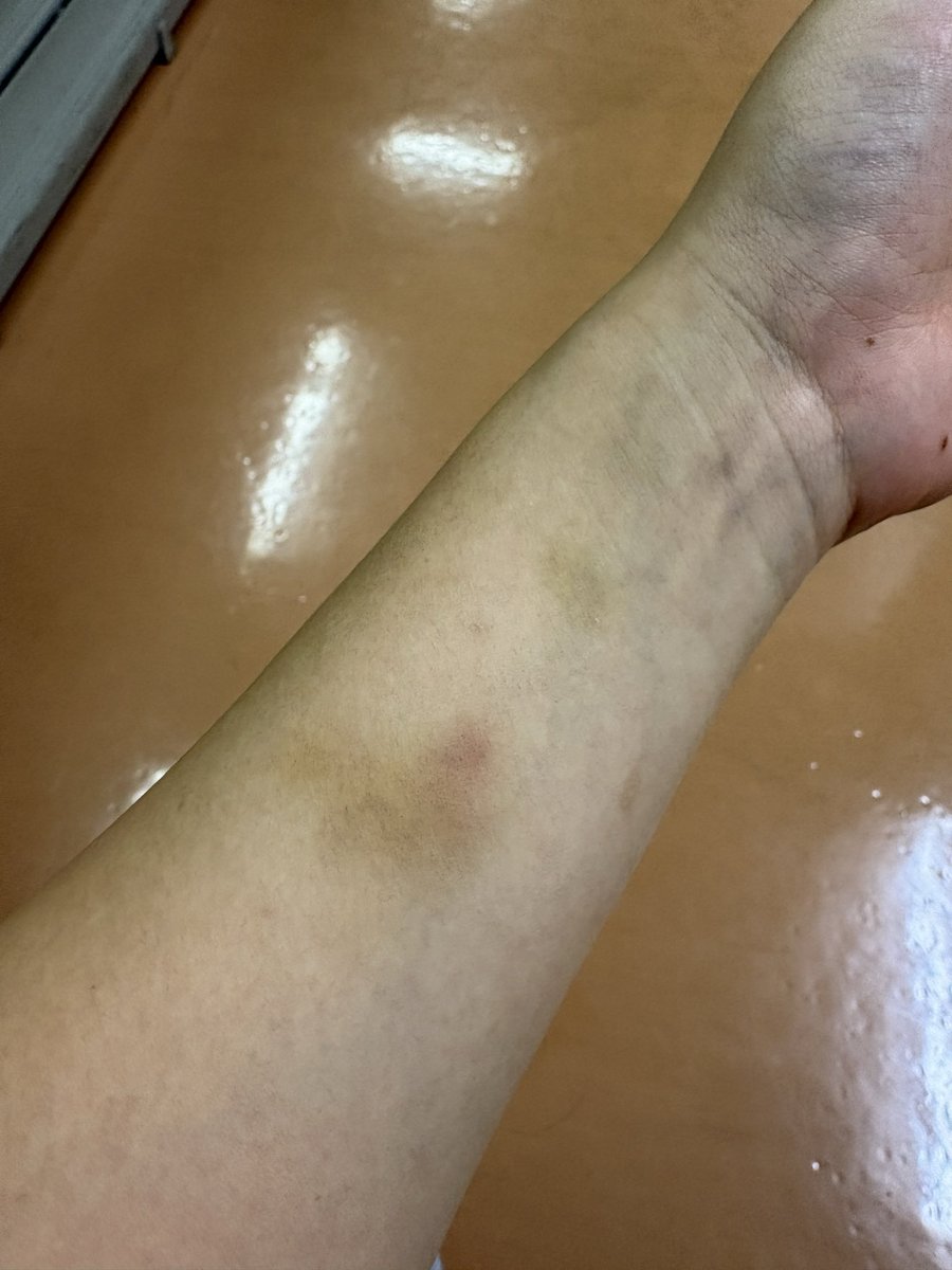 chika_04125's tweet photo. 腕汚くてごめんね
なぜか両腕にアザあるんだけど笑 https://t.co/ETzTQp2ZH3