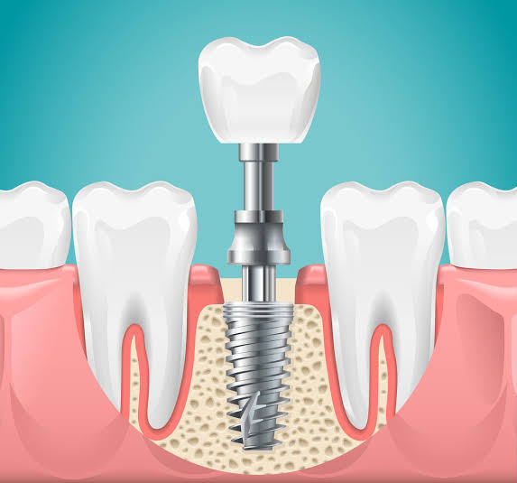 gunebakis02's tweet photo. Dişinize Takılan İmplantın Kimliğini Sorun!

Hasta Hakları Dernek Başkanı Yusuf Babar’dan implant uyarısı: “Belgesiz implant, gelecekte hastayı zor durumda bırakabilir”
👇
https://t.co/Hcnkb8yyyA
@mSencer1071 https://t.co/yTUF1dj8Am