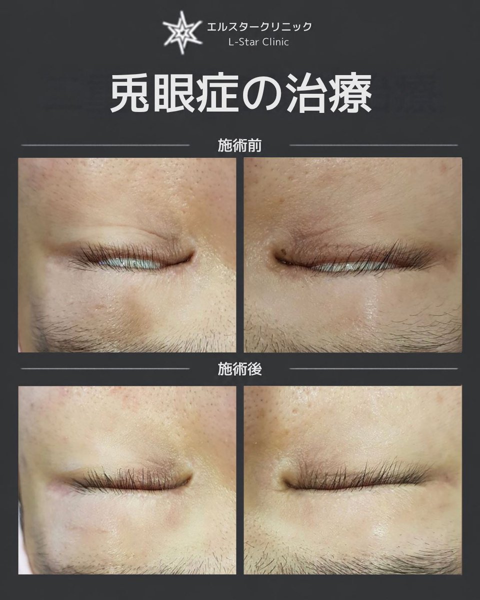 skinmaster0308's tweet photo. 🫶【二重再手術後の兎眼（目が閉じきらない状態）と傷痕、レーザー治療２回で改善した症例】  

「二重整形とその後の再手術を経て、目が完全に閉じなくなってしまいました」

今回ご来院された方は、以前受けた二重整形手術の傷痕にお悩みで、さらにその修正のために受けた再手術によって症状が悪化し、目が閉まらない兎眼（とがん）を発症してしまった患者様です。

朝起きた時の目の乾燥や痛み、視力の低下など、日常生活で大変大きな苦痛を感じていらっしゃいました。  

他の美容外科では治療不可と診断されるか、確実性の低い手術を提案されるのみで諦めかけておられましたが、当院のレーザー治療を受けていただくこととなりました。

[施術前の状態]

左右どちらの目も、普通に閉じようとしても完全に塞がらず、白目が大きく露出してしまう状態でした。  

[２回の治療後の変化]

わずか２回のレーザー施術を経て、驚くべき改善が見られました。  

 目が完全に閉じる状態へ回復：自然に目を閉じた際、白目が一切見えなくなり、まぶたがしっかりと眼球を覆うようになった  
 開閉の快適性と印象の改善：目の開け閉めが非常にスムーズになり、まぶたの緊張がほぐれて目元の印象も柔らかくなった  

[治療のポイント]

二重手術の副作用でお悩みの方の多くが再手術を選択されますが、かえって組織の損傷を招き、症状が悪化してしまうケースも少なくありません。

手術による修正が困難なケースであっても、適切なレーザー治療によって皮膚組織の柔軟性を取り戻すことで、安全に症状を改善することができます。
患者様が心の安らぎを取り戻された姿を見ることは、施術を担当した医師として非常に誇らしく嬉しい瞬間です。

後遺症でお悩みの方も、決してあきらめずに当院までご相談ください。

#二重整形後遺症 #兎眼 #目が閉じない #二重整形失敗 #切開傷痕 #皮膚再生 #韓国整形 #渡韓整形 #美肌治療 #韓国美肌 #肌質改善 #トーンアップ #肌再生 #韓国美容 #美容皮膚科 #目元ケア
#エルスタークリニック