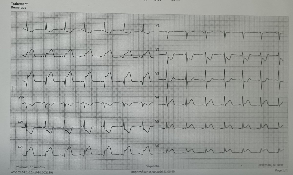 FibrilloFlutter's tweet photo. What is the culprit artery ⁉️⁉️⁉️
#ECG
#Cardiology
#MedicalEducation
#coro https://t.co/P2L3E8ZeX4