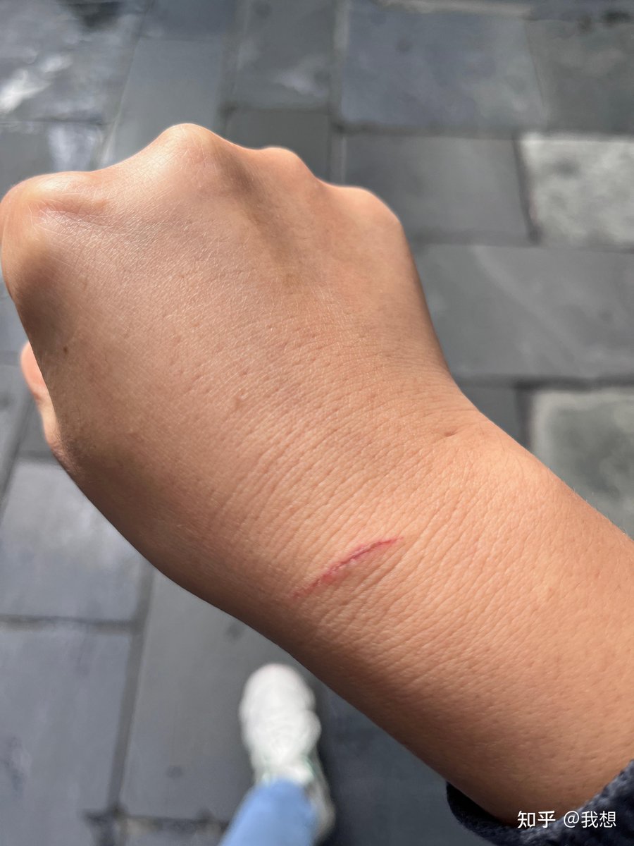 kcpark0401's tweet photo. This scar still reminds me of the smart, gentle guy I once knew, and every time I see it, it comforts me to cherish the little happy moments we had. https://t.co/us6QQfpmCa