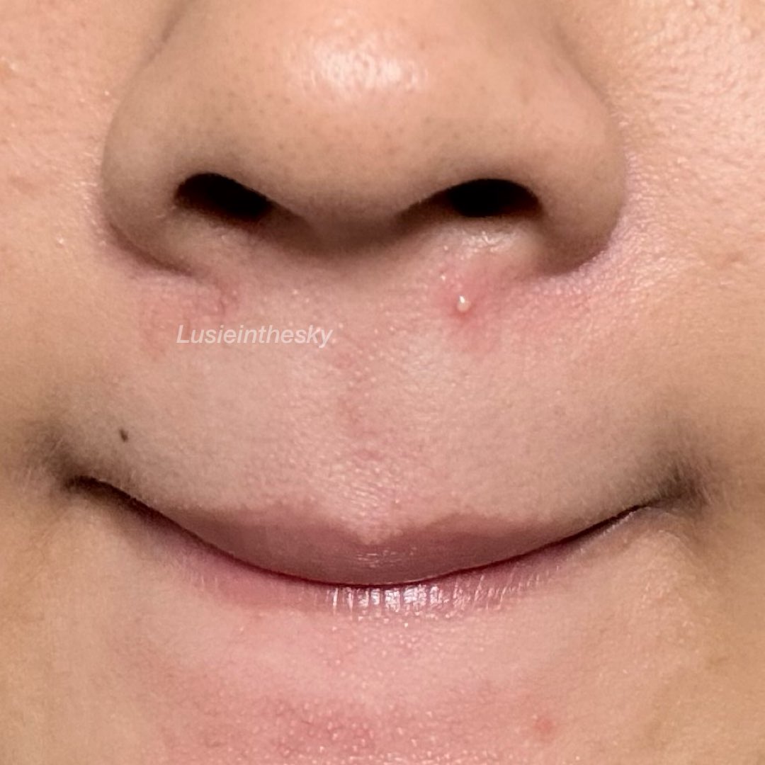 Lusieinthesky's tweet photo. aku sering bgt muncul jerawat di bawah hidung kek gini, litereli muter2 aja di area kumis. ada yg sama juga gak sih? https://t.co/LecO3vGmRD