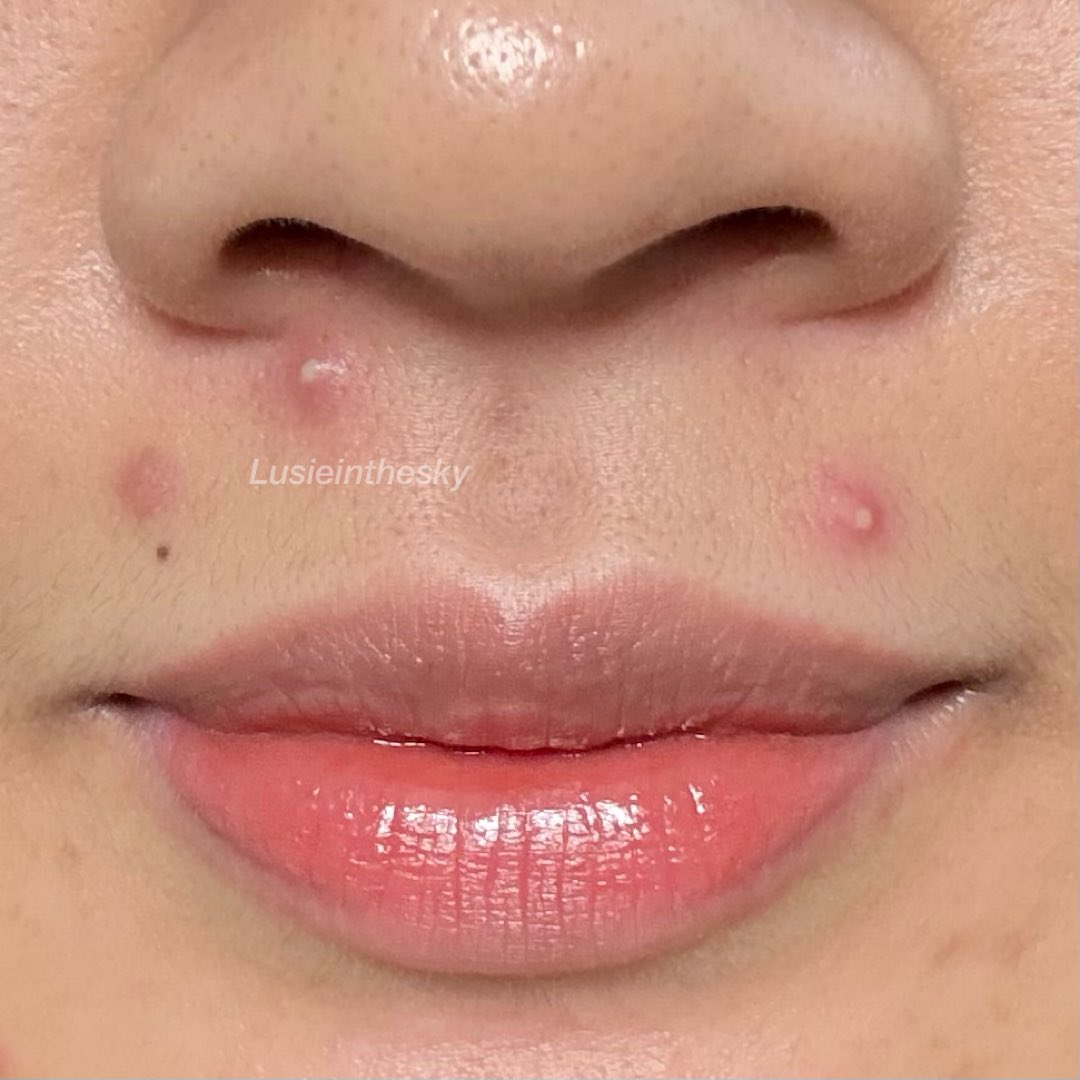 Lusieinthesky's tweet photo. aku sering bgt muncul jerawat di bawah hidung kek gini, litereli muter2 aja di area kumis. ada yg sama juga gak sih? https://t.co/LecO3vGmRD