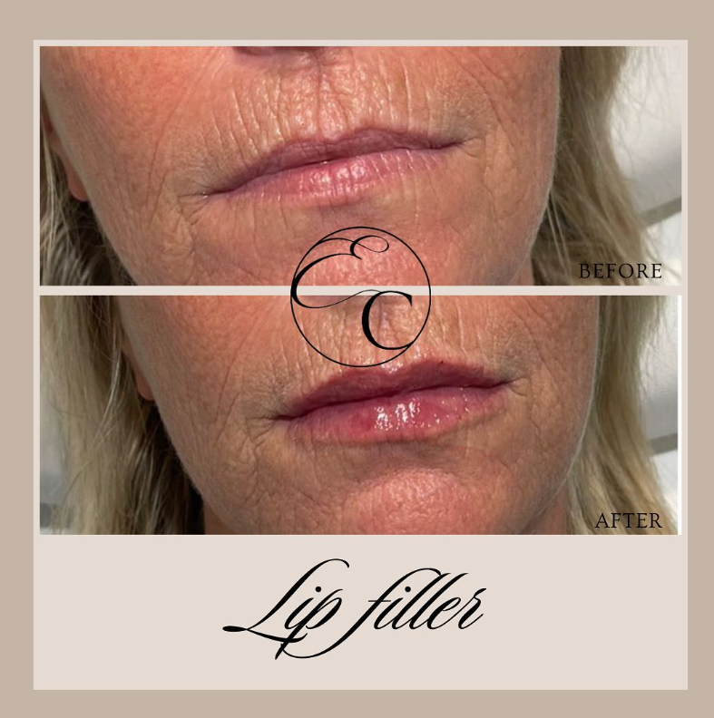 EnhanceClinicBe's tweet photo. 𝐋𝐢𝐩 𝐟𝐢𝐥𝐥𝐞𝐫 👄

Lip filler touch up for this lovely lady!
Visit: https://t.co/XeHtd8yKsi
🕣 Appointment time: 20 min
🤕 Downtime: Bit of swelling and bruising can accur, allow two weeks to fully settle.

#enhanceclinic #aesthetic #ghent #botox #beauty #fillers #skincare https://t.co/1Tm3PlooCa