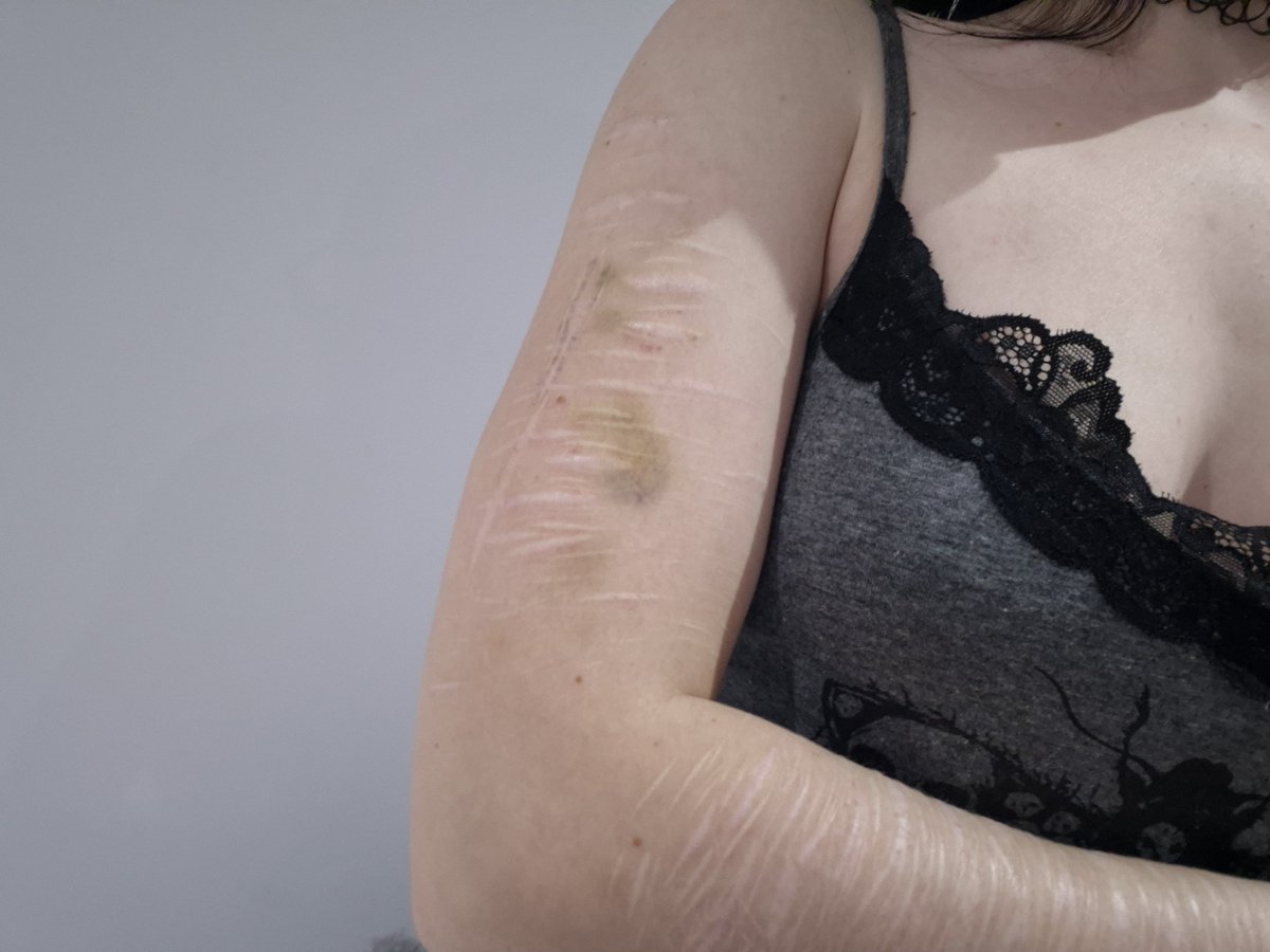 deathcli_max's tweet photo. Told my fwb to punch me and he barely left a bruise so I punched myself until I had a bigger bruise and now am rage baiting and saying hes weak and I bruise mogged him so hopefully he actually hits me hard next time #saneaf https://t.co/R6AIHbE7P9