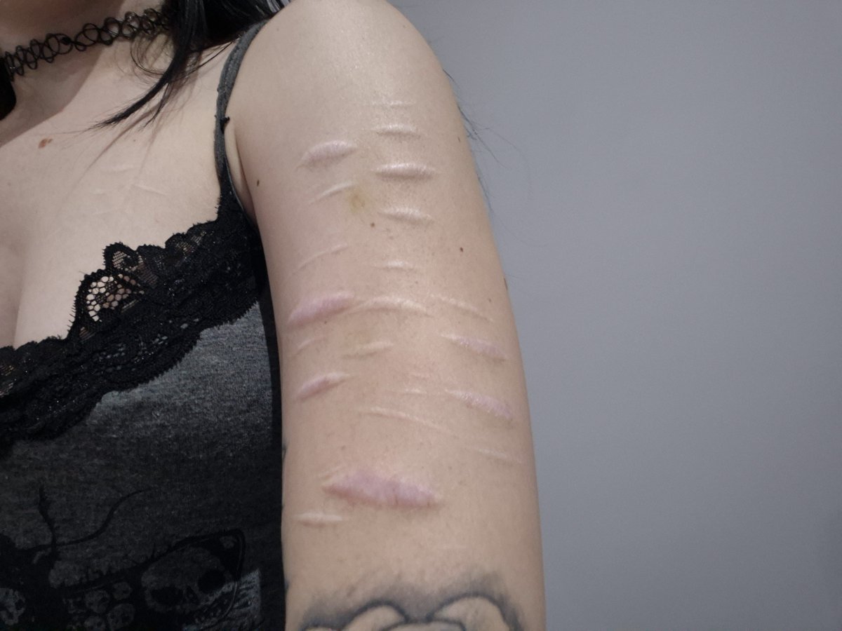 deathcli_max's tweet photo. Told my fwb to punch me and he barely left a bruise so I punched myself until I had a bigger bruise and now am rage baiting and saying hes weak and I bruise mogged him so hopefully he actually hits me hard next time #saneaf https://t.co/R6AIHbE7P9
