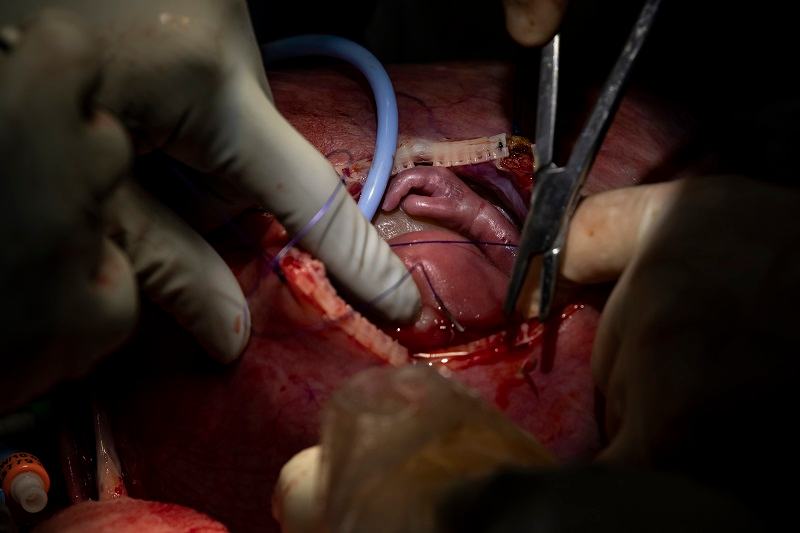 LifeNewsHQ's tweet photo. An unborn baby girl was removed from her mother's womb for lung surgery and then put back in the womb.

You can't do that with a clump of cells or a blob of tissue.

But doctors can do that with a baby.

Read more below... https://t.co/a96zt6ujY2