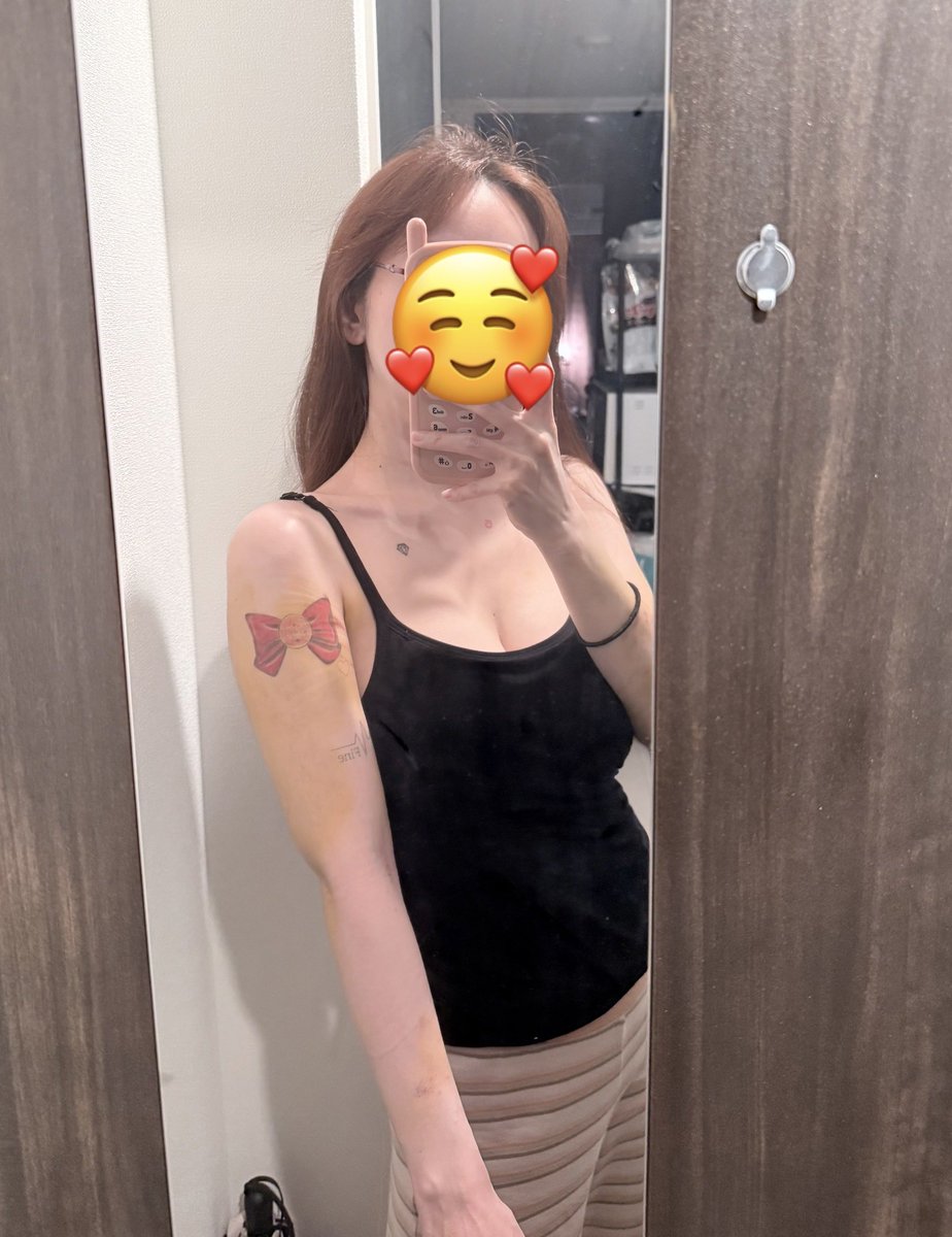 二の腕脂肪吸引、DT6日目。
まだまだ結構腫れてるけど、腫れ引くの楽しみ。
痛みは徐々に減ってきてる感じ。 https://t.co/UA7WPS3pHE