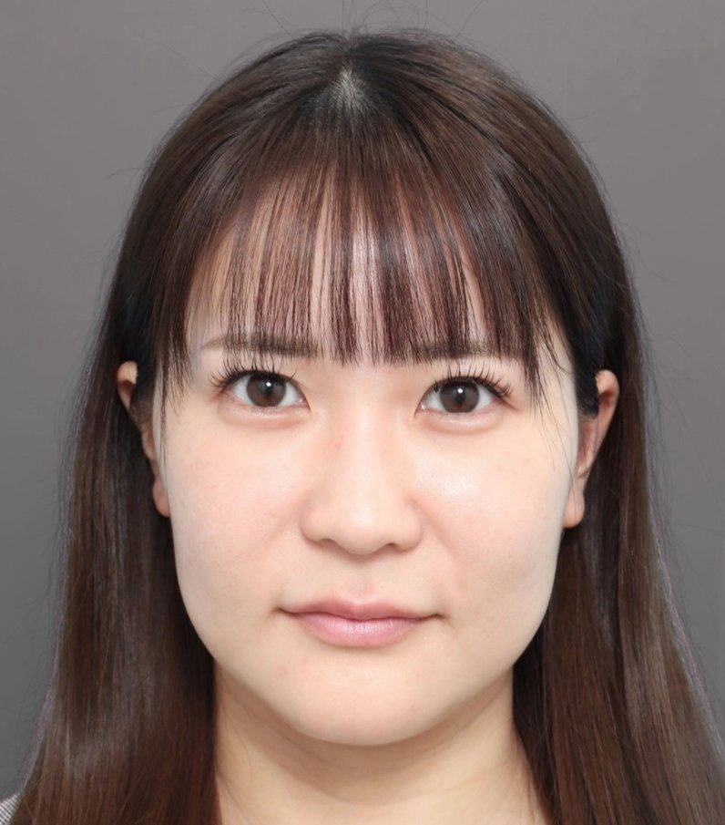 drlee_verite's tweet photo. フェイスリフトは意外と腫れにくい手術です。 

腫れるイメージを持たれてる方が多いですがヴェリテクリニックでは中の組織からしっかり引き上げる為腫れにくいのが特徴です。  

左から手術前→3日目→1か月後のダウンタイム写真です。 
#フェイスリフト #ダウンタイム #頬リフト #頸部リフト https://t.co/QKnxooSthc