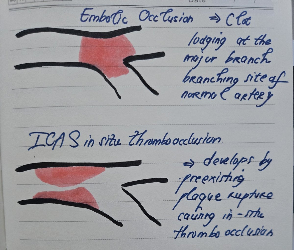 pusparani10's tweet photo. ICAS related LVO

#LVO
#Stroke
#MedEd
#Drawing https://t.co/dxQWveI65o
